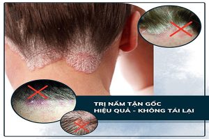 Mua thuốc trị nấm da đầu tại Hải Dương 8