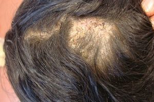 Mua thuốc trị nấm da đầu tại Hòa Bình