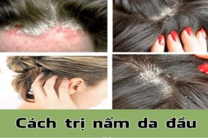 Mua thuốc trị nấm da đầu tại Quảng Bình 8