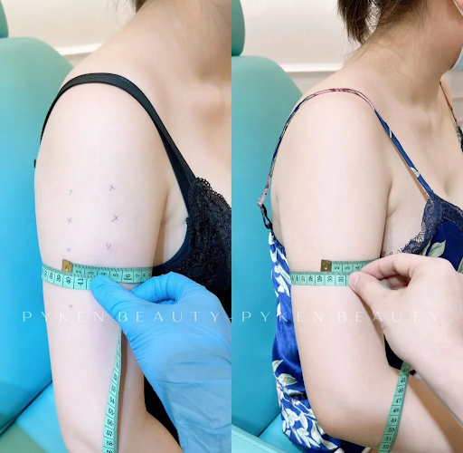 Lý giải cơn sốt của dịch vụ tiêm botox bắp tay giảm béo 3 tiem botox bap tay giam beo 1
