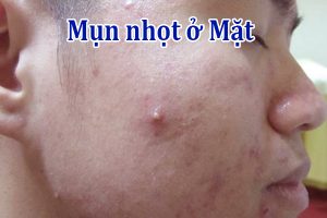Mụn nhọt ở Mặt