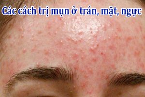 Các cách trị mụn ở trán, mặt, ngực