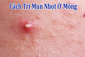 Cách Trị Mụn Nhọt Ở Mông