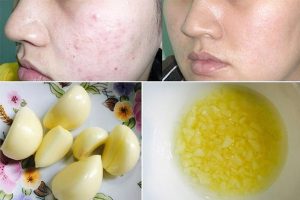Cách làm mụn nhanh chín bằng tỏi