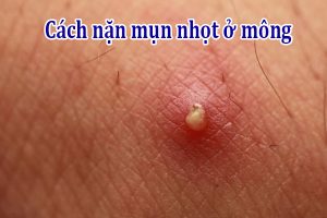 Cách nặn mụn nhọt ở mông