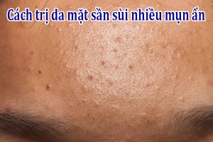Cách trị da mặt sần sùi nhiều mụn ẩn