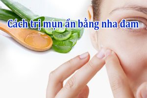 Cách trị mụn ẩn bằng nha đam