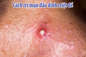 Cách trị mụn đầu đinh (mụn đinh râu) triệt để