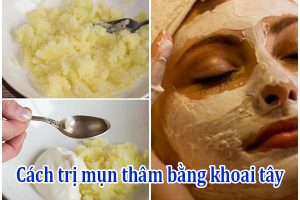 Cách trị mụn thâm bằng khoai tây
