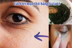 Cách trị mụn thịt bằng lá tía tô