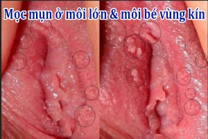 Mọc mụn ở môi lớn