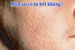 Mụn ẩn có tự hết không