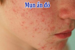 Mụn ẩn đỏ