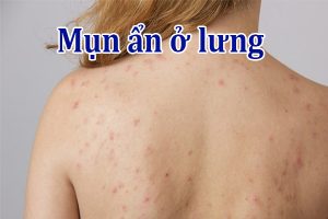 Mụn ẩn ở lưng