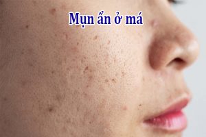 Mụn ẩn ở má