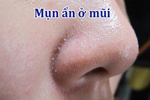 Mụn ẩn ở mũi