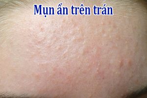 Mụn ẩn trên trán