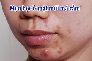 Mụn bọc ở mặt mũi má cằm