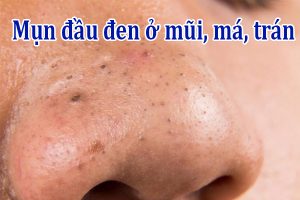 Mụn đầu đen ở mũi, má, trán