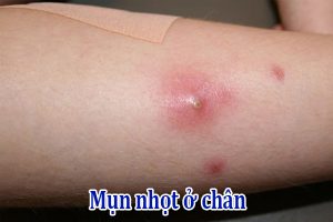 Mụn nhọt ở chân
