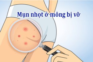 Mụn nhọt ở mông bị vỡ có nguy hiểm không