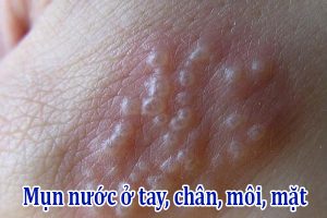 Mụn nước ở tay, chân, môi, mặt