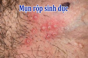 Mụn rộp sinh dục