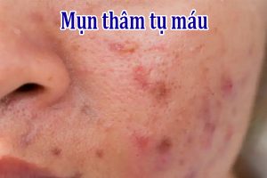 Mụn thâm tụ máu: nguyên nhân và cách điều trị tại nhà