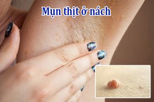 Mụn thịt ở nách