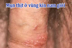 Mụn thịt ở vùng kín nam giới