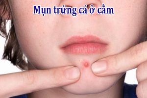 Mụn trứng cá ở cằm
