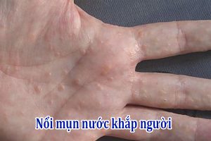 Nổi mụn nước khắp người