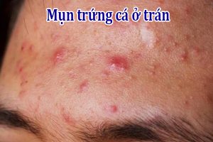 Mun trung ca o tran