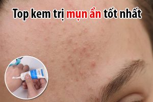 Top 5 kem tri mun an tot nhat hien nay