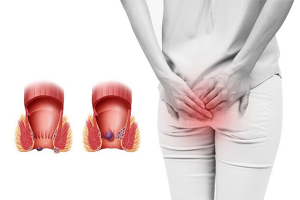 Top 3 thuốc bôi trĩ tốt nhất hiện nay