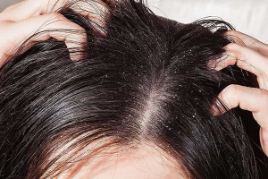 Nguyên nhân gây nấm da đầu