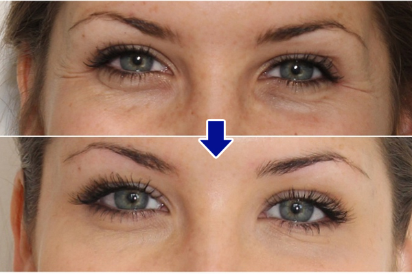 Hiệu quả trước và sau khi dùng kem dưỡng mắt thường xuyên