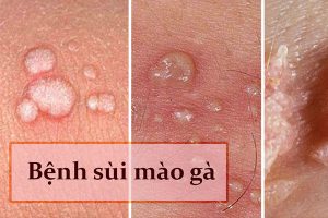 Bệnh sùi mào gà