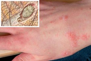 Bệnh ghẻ nước do ký sinh trùng Sarcoptes scabiei hominis