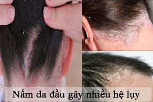 Địa chỉ mua thuốc trị nấm da đầu tại Ninh Bình uy tín
